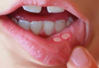 سرطان دهان