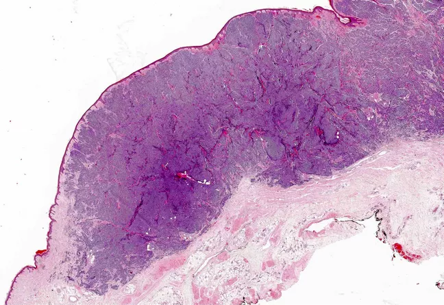 Medicines to treat Merkel cell 2