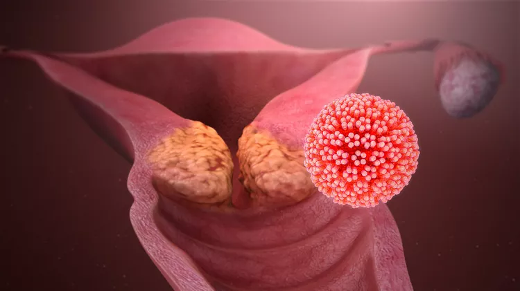 1600px HPV causing cervical cancer