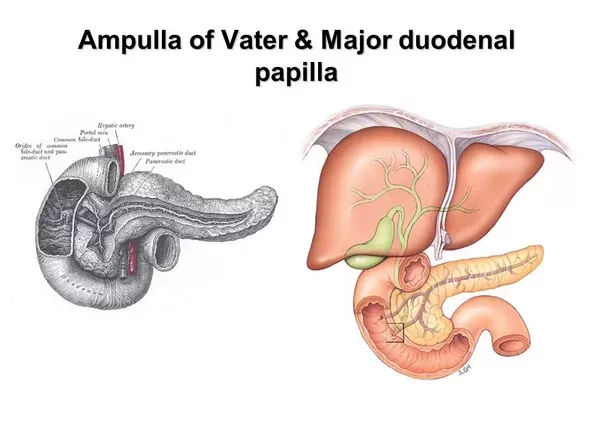 سرطان آمپولاری یا آمپول واتر