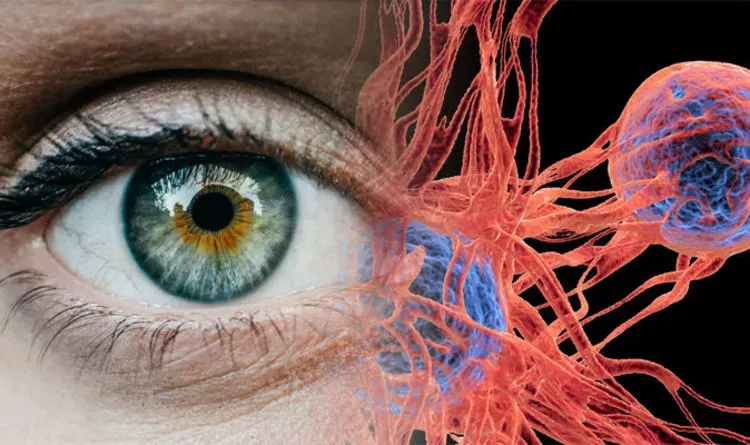 درمان سرطان پلک